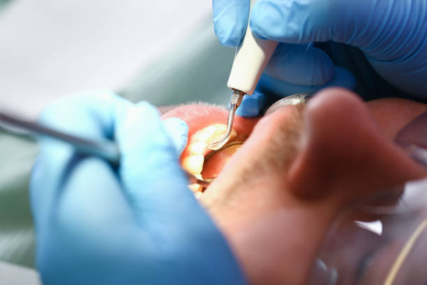 Best Emergency Treatment for Dental Infections or Abscesses in Nd Lake, WI